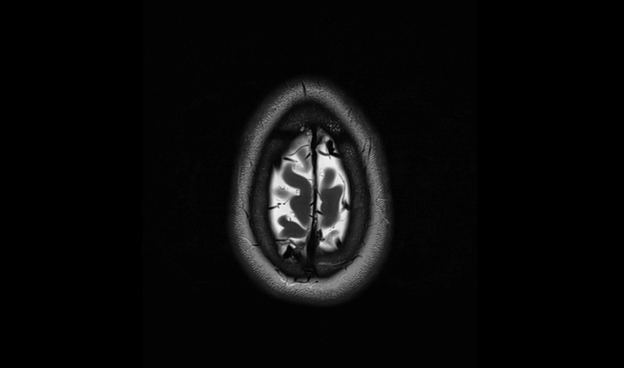 Brain cisterns  and ventricles  axial anatomy 3T MRI image-img-00001-00056.webp